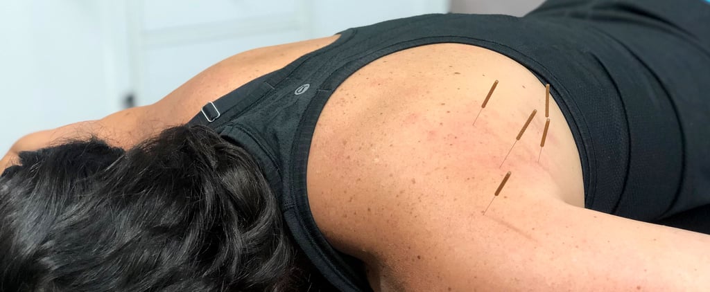What's It Like to Get Dry Needling, and Does It Hurt?