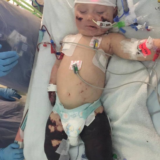 Boy With Amputations From Meningitis Takes First Steps