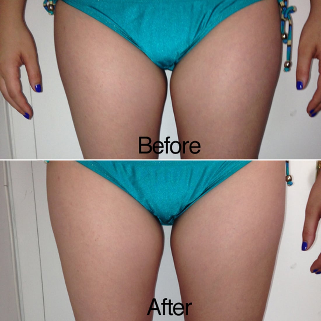 Laser Fat Removal Results POPSUGAR Beauty