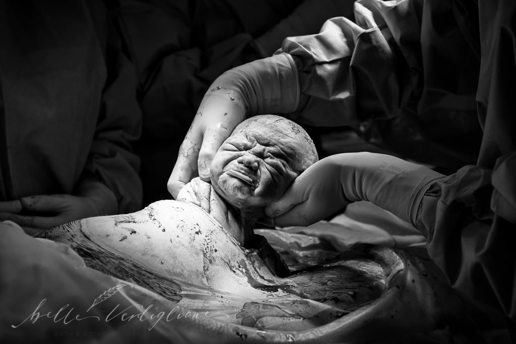 C-Section Mom Watching Baby's Birth