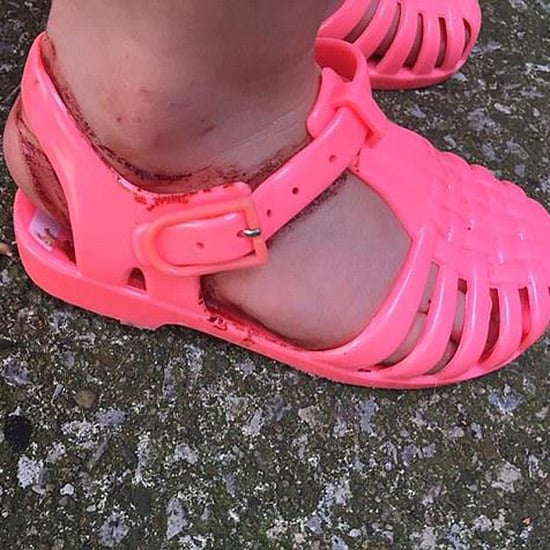 Jelly Sandals Left Girl's Feet Bleeding and Bruised