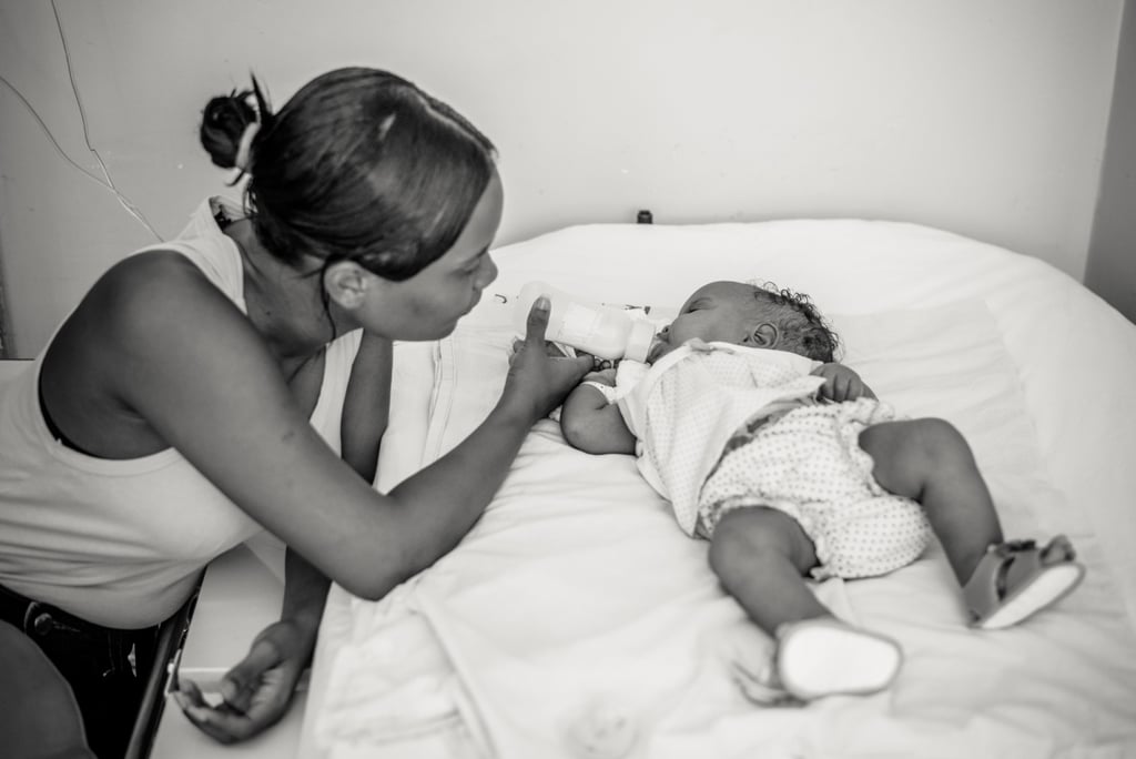 Conjoined Twins Are Separated and Photographed