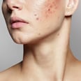 Acne Flare-Up? We Ask the Experts For the Best Acne Treatments