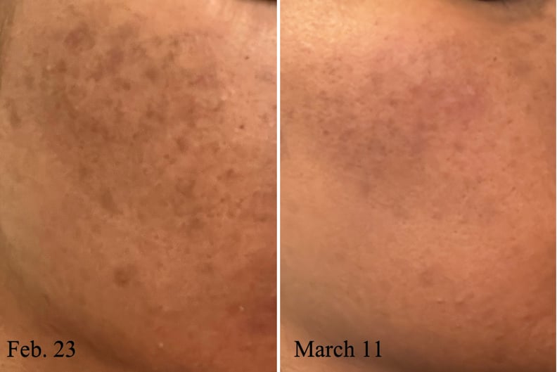Before and after results on woman's skin using the Dr. Dennis Gross Skincare Vitamin C Lactic 15% Firm and Bright Serum for 16 days.