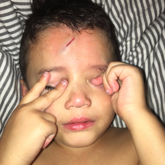 Mom Turns Son's Scar Into Harry Potter Lightning Bolt