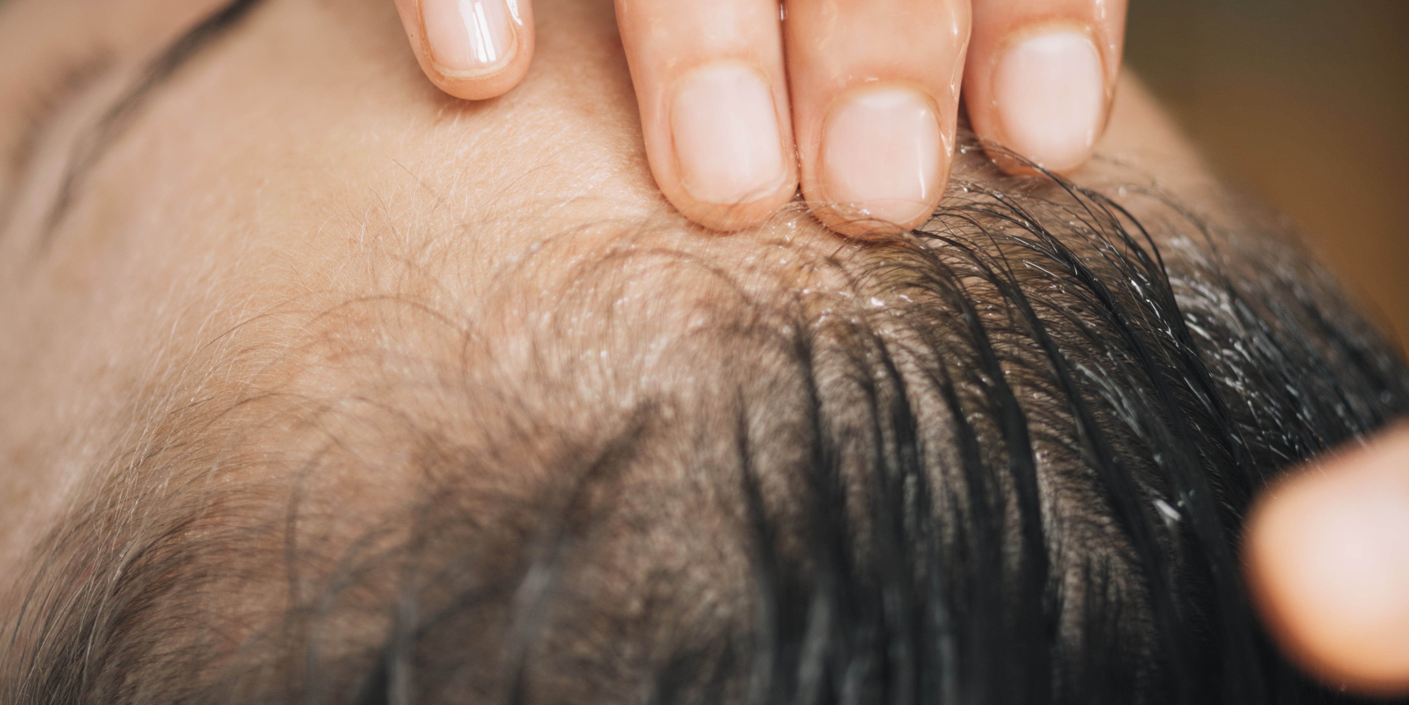 Hair Cracking: About the Dangerous Scalp Popping Trend - Vimarsana News