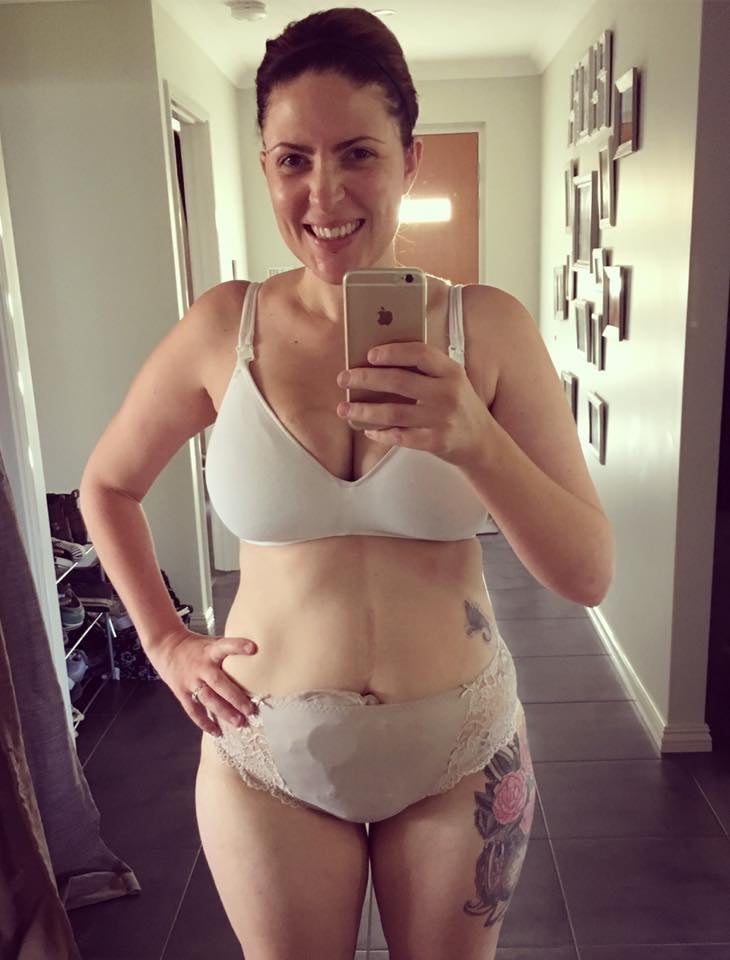 Mom's Selfies With Ileostomy Bag