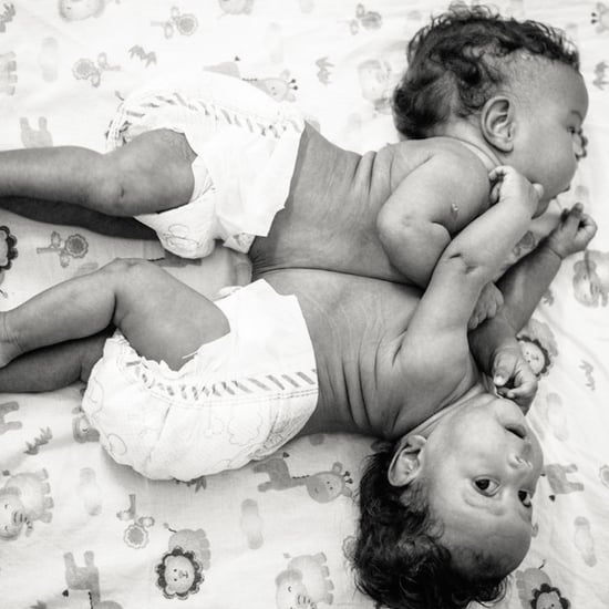 Conjoined Twins Are Separated and Photographed