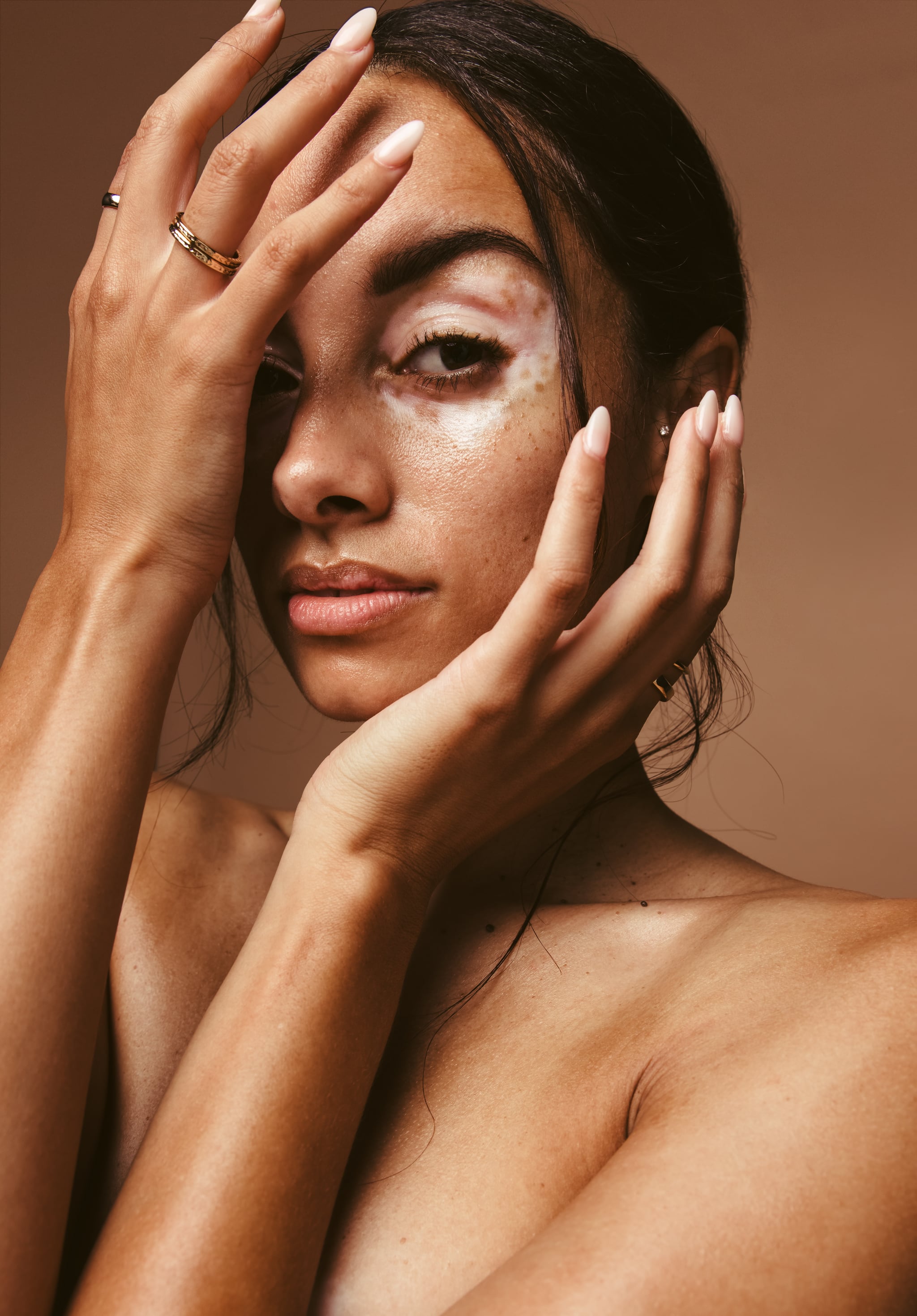 Hypopigmentation is the opposite of hyperpigmentation and is when lightened patches form on the skin  