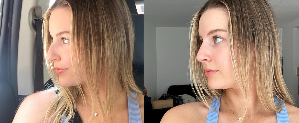 I Got a Liquid Nose Job: See Before and After Photos