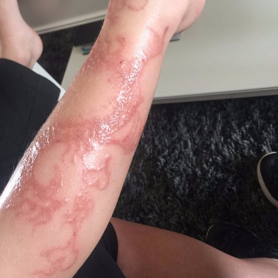 Kid's Allergic Reaction to Henna Tattoo