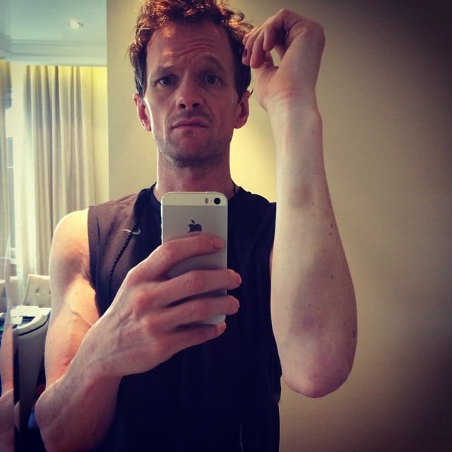 Neil Patrick Harris showed off a bruise he got during Hedwig and the Angry Inch.
Source: Instagram user instagranph