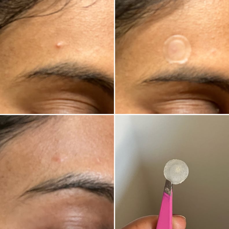 Results using the Good Molecules Pimple Patch