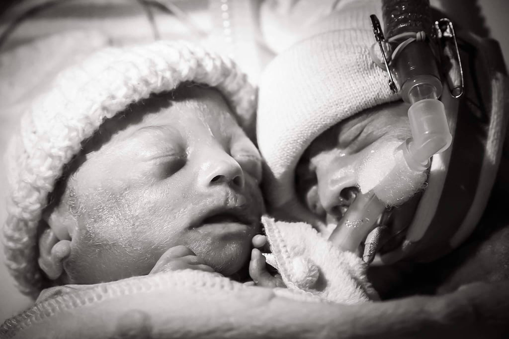 The twins with twin to twin transfusion syndrome Heartbreaking Birth Stories POPSUGAR Family
