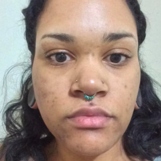 Color-Correcting Acne Scars Before and After