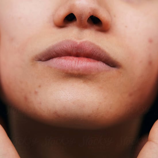 How to Remove Blackheads At Home, According to a Facialist