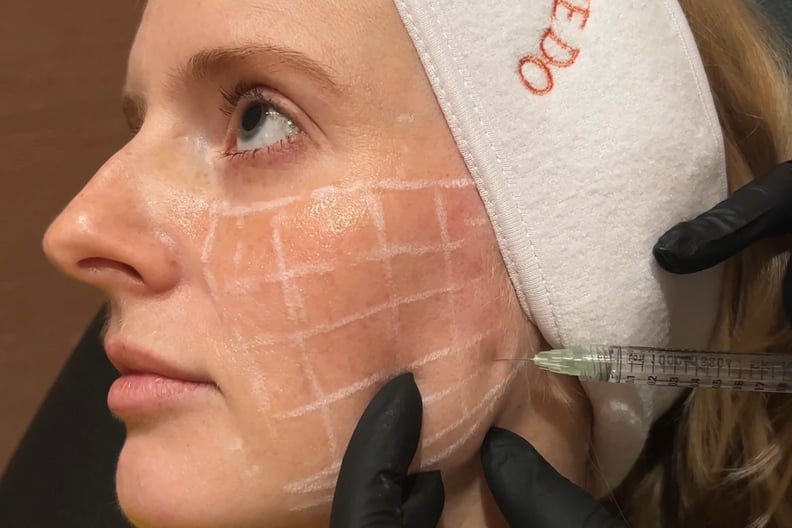 Getting skinvive, a new hyaluronic acid filler to smooth uneven skin texture