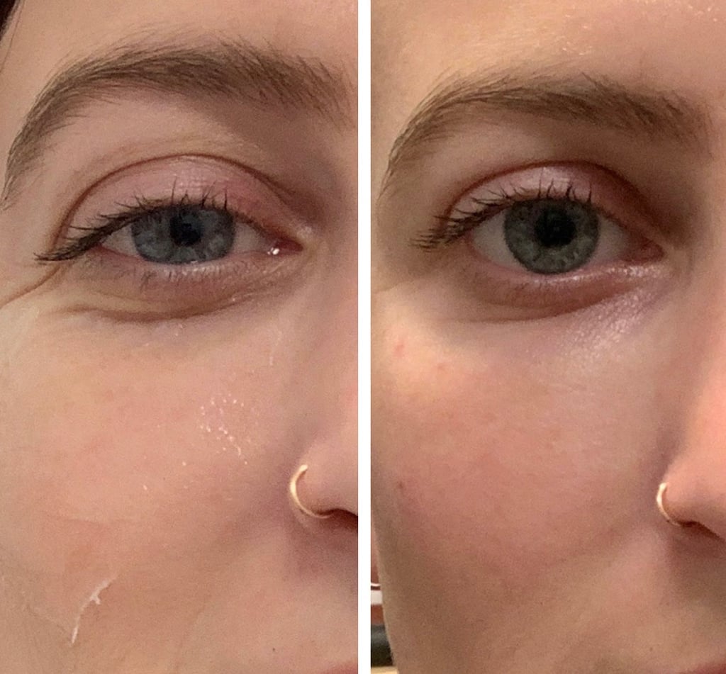 Undereye Filler Before and After POPSUGAR Beauty