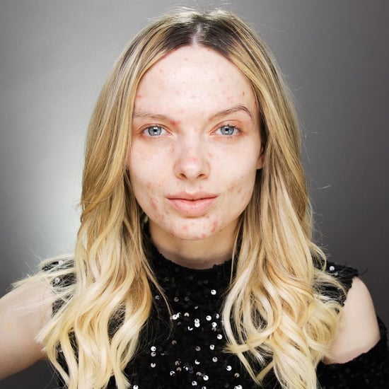 Beauty Influencer Quotes About Acne