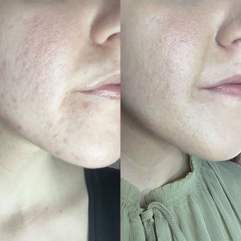 Dr. Dennis Gross Skincare Breakout Solution on Inflamed Acne