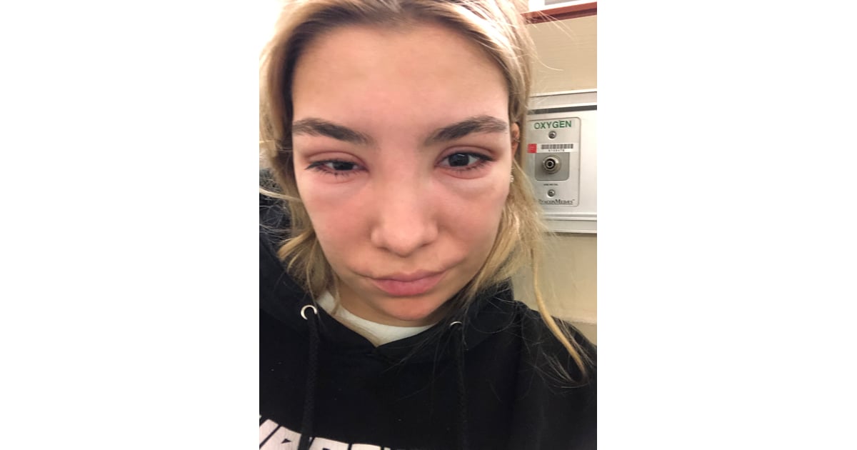 3 Days After the Lash Tint Allergic Reaction to Eyelash Tint Treatment POPSUGAR Beauty Photo 3