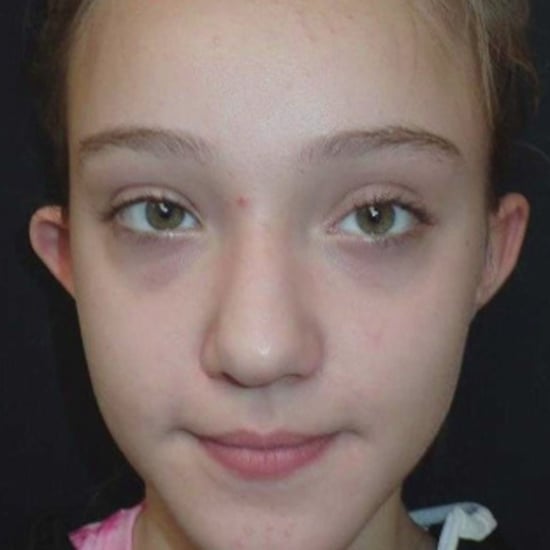 Virginia Girl Gets Plastic Surgery Because of Bullying