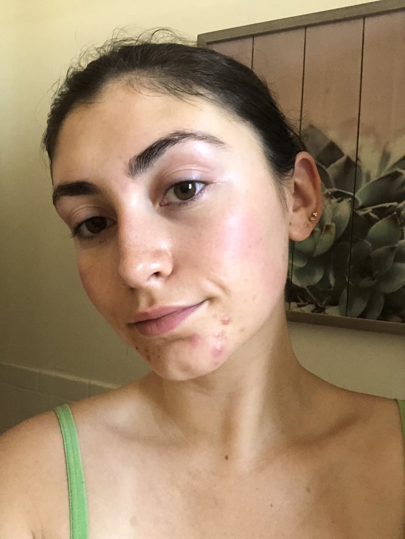 3 Days After Using the Dr. Dennis Gross Blemish Solutions Acne Eliminating Gel