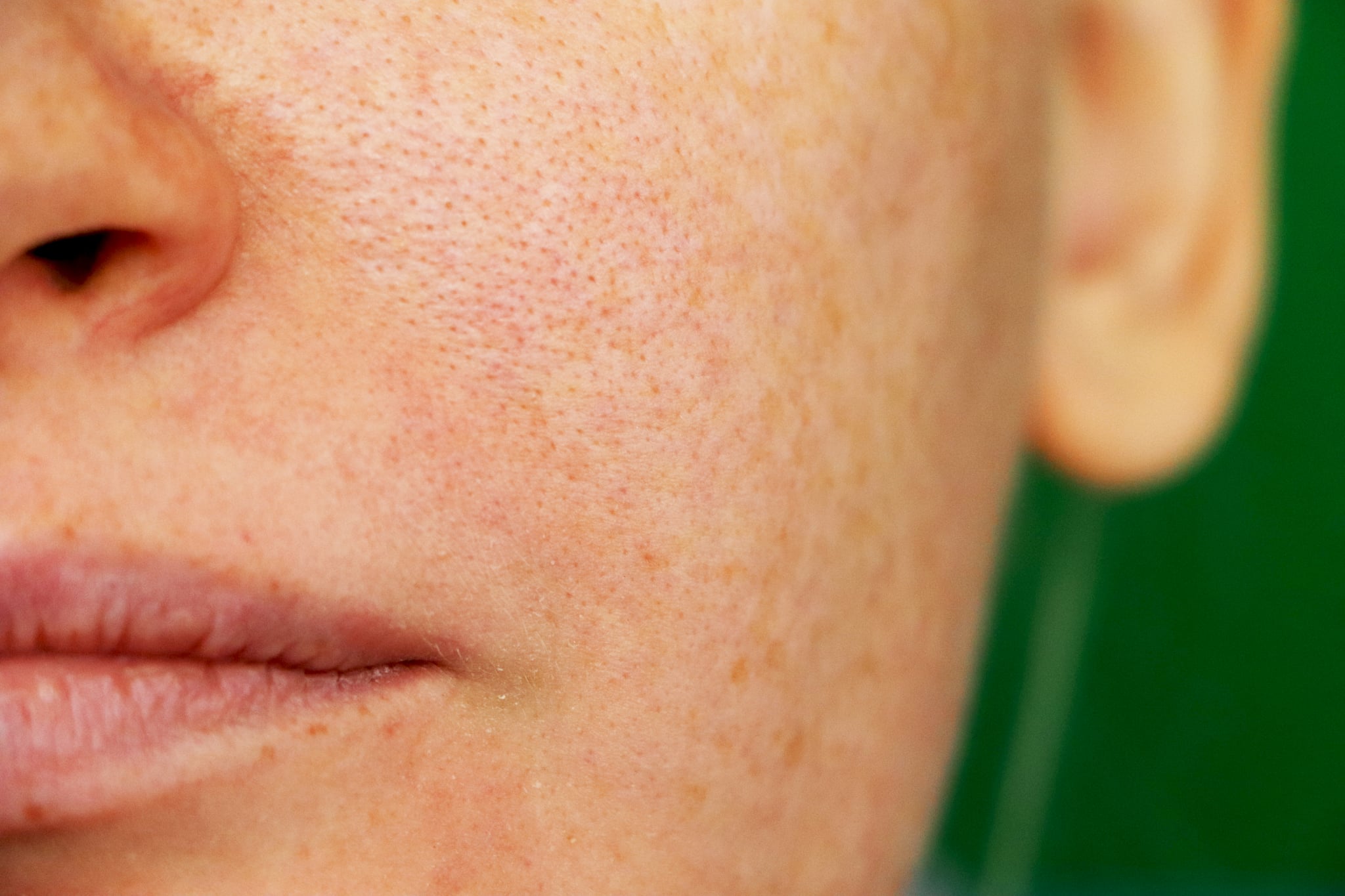 Girl with problem skin. Freckles, pigmentation, enlarged pores.