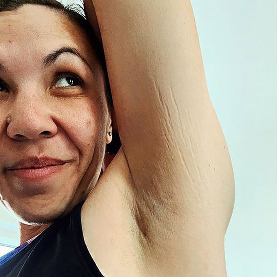 Woman Shares Photo of Arm Stretch Marks to Show It's Normal