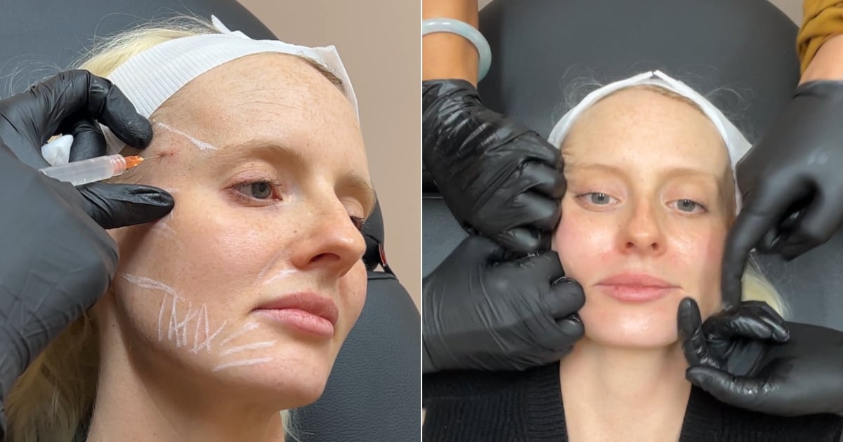 I Tried the “No-Volume” Filler Sculptra to Look Less Tired — and It Worked