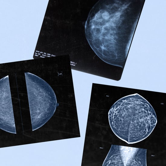 What to Know About AI Mammograms