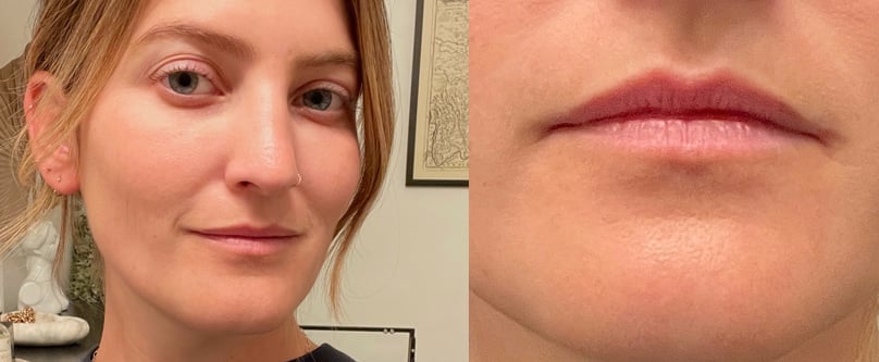 I Tried Cheek Filler: See Before and After Photos