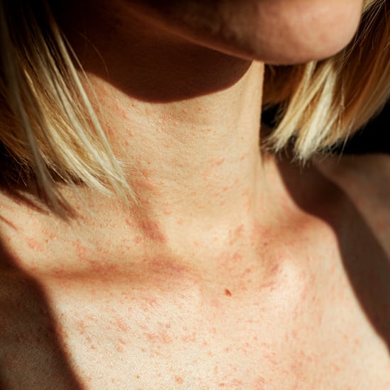 5 Eczema Hacks to Try, According to Doctors