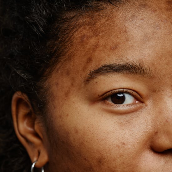 Acne and Vitamin Deficiencies: What You Should Know