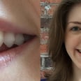 11 Things I Wish I'd Known Before I Got Invisalign