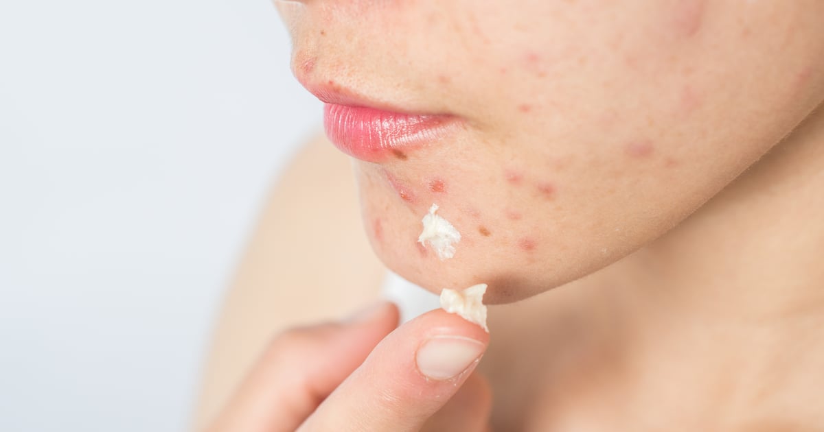What To Do After Popping A Pimple Tips And Treatments Popsugar Beauty