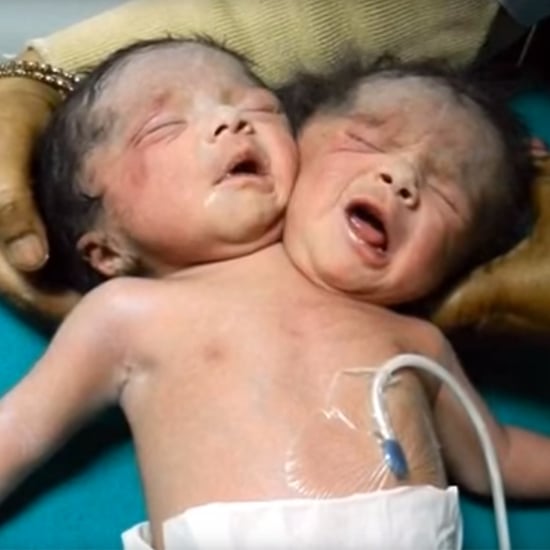 Baby in Bangladesh Born With 2 Heads