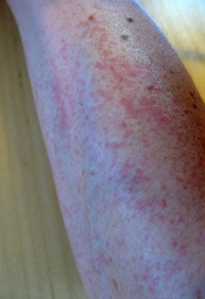 Garden Rash