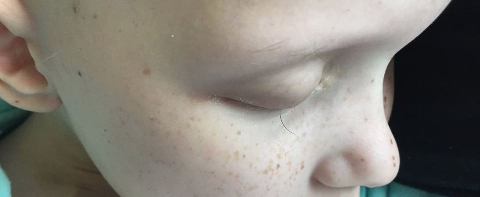 Photo of Girl With Cancer's Last Eyelash