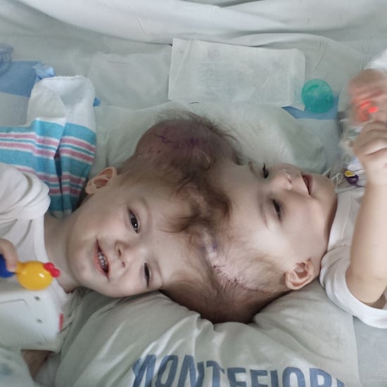 Twin Boys Conjoined at the Head Separated