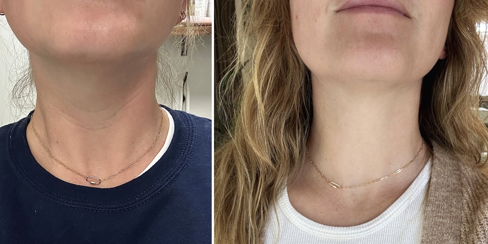 I Got Neck Botox to Treat My Tech Neck Wrinkles — and It Worked