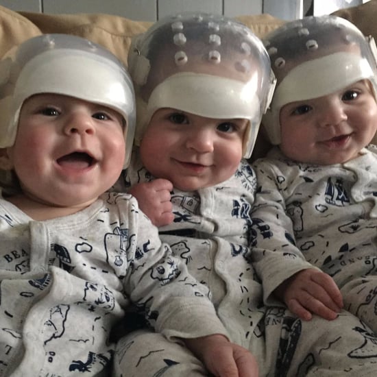 Triplets All Born With Rare Skull Defect