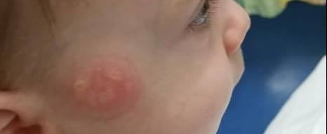 Mom's Warning on Pacifiers After Son Gets Burned