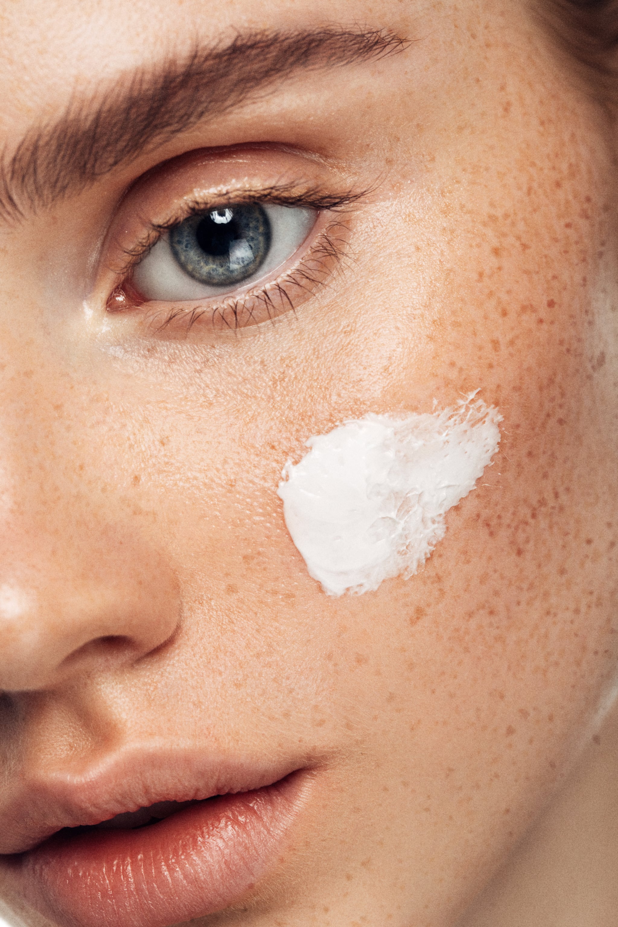 why acne prone skin