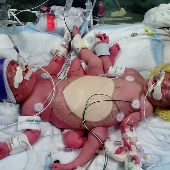 Rare Identical Triplets and Conjoined Babies Born in Texas