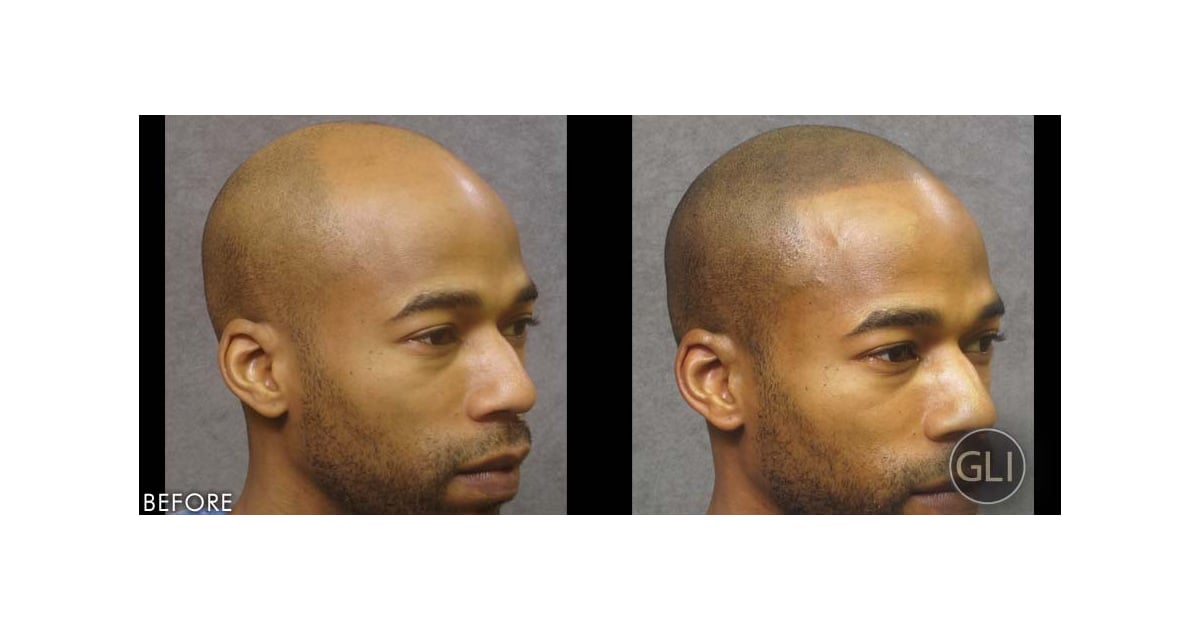 Hair Tattoos For Baldness | POPSUGAR Beauty Photo 10