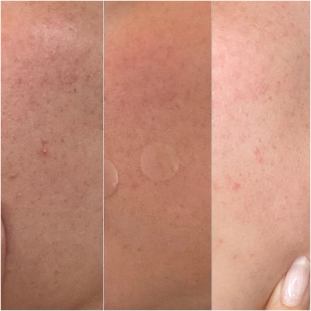 Best Acne Patches For Cluster Breakouts