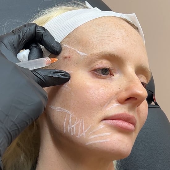 I Tried Sculptra: See Before and After Photos