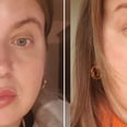 I Got Radiofrequency Microneedling — Here's What It Did For My Skin