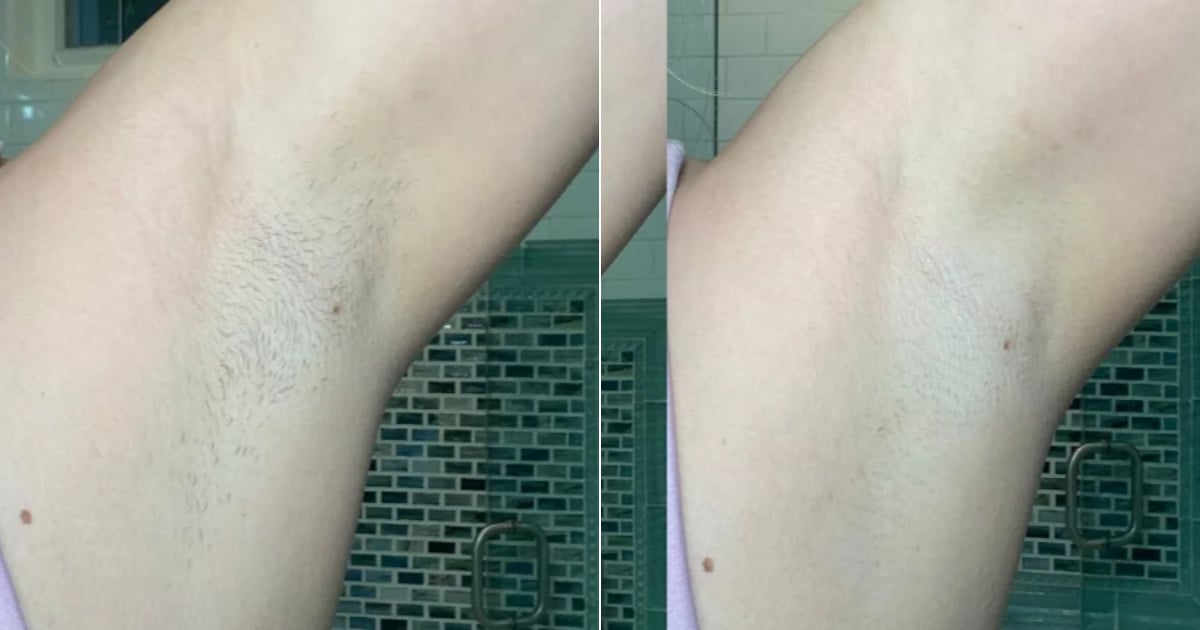 I Tried Ulike’s At-Home Hair-Removal Laser